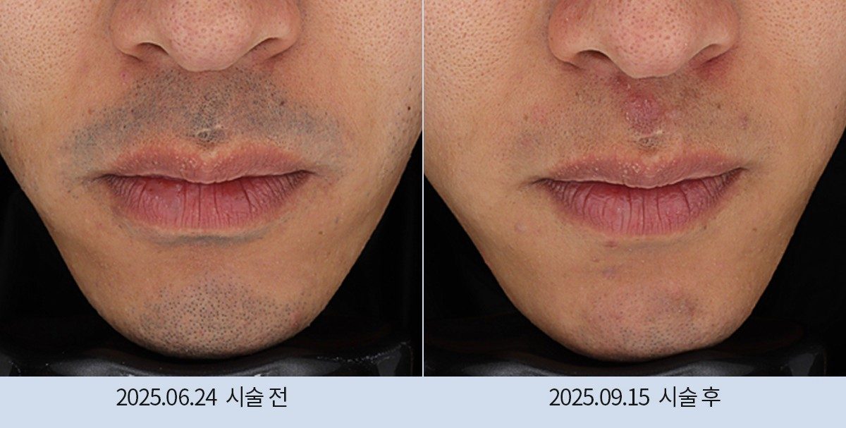 스노우의원 다산점 레이저 제모 전후