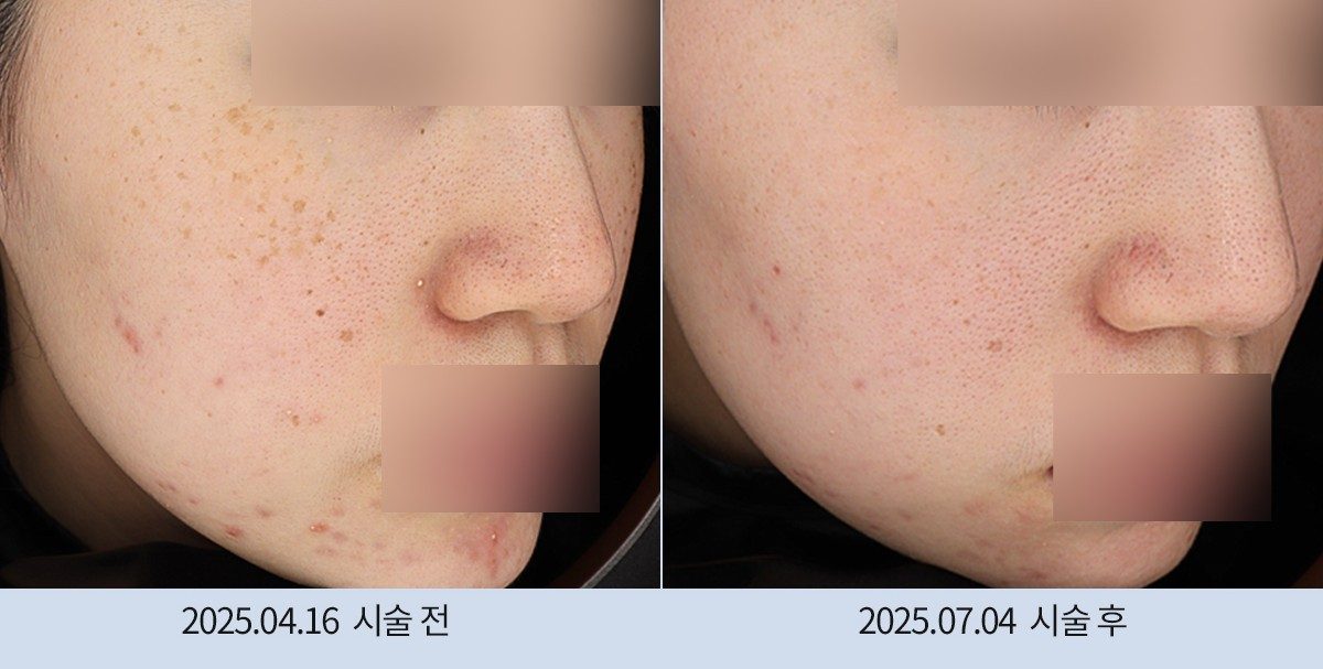 스노우의원 다산점 색소 시술 전후