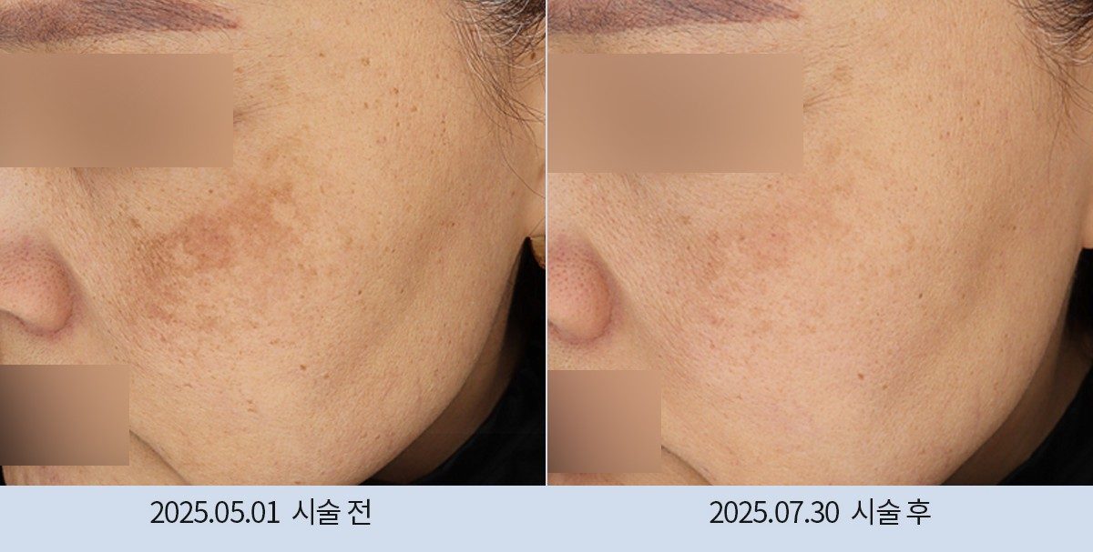스노우의원 다산점 색소 시술 전후