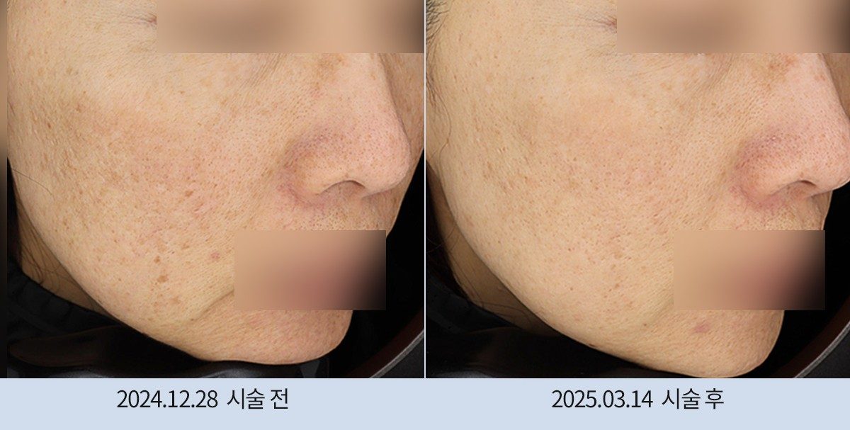 스노우의원 다산점 색소 시술 전후
